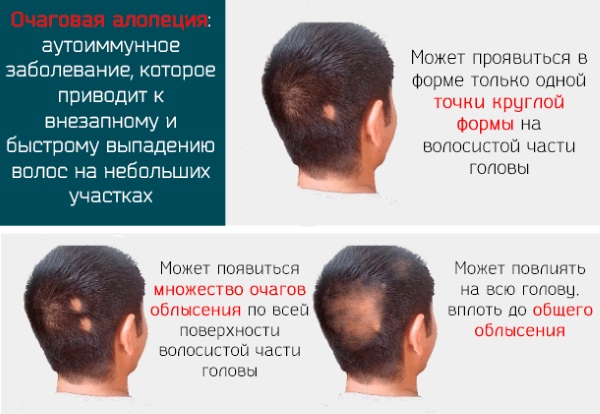 Как делают плазмолифтинг против выпадения волос 