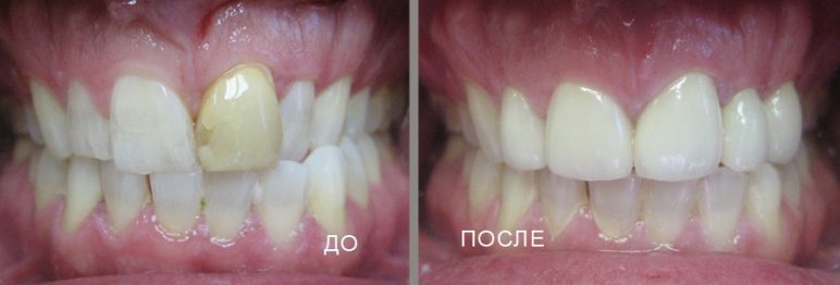 Какие коронки лучше ставить на передние зубы 