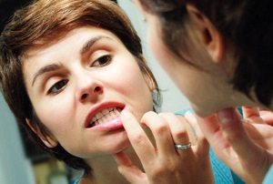 Как избавиться от шишек на деснах после удаления зуба? 