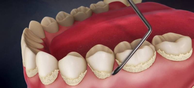 Как избавиться от зубного камня в домашних условиях 