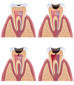 Как лечат кариес между зубов – самую сложную форму кариозного поражения 