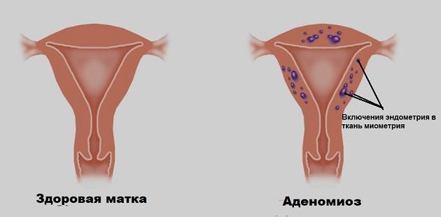 Как забеременеть при аденомиозе 