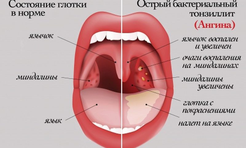 Как лечить бактериальный тонзиллит? 