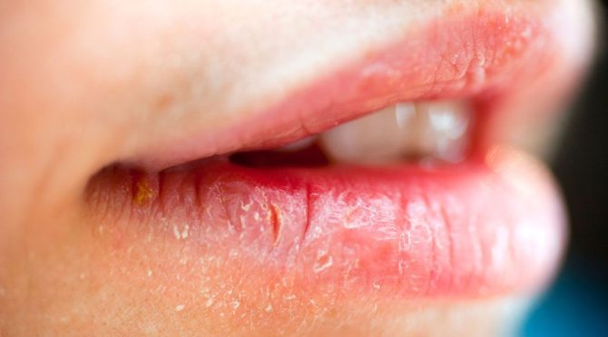 Как лечить хейлиты на губах, причины, симптоматика, виды 