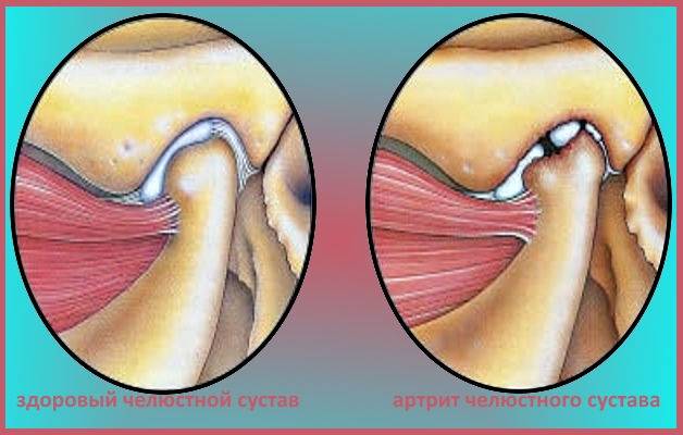 Какое лечение назначают при артрите челюсти: препараты, физиотерапевтические мероприятия, специальные упражнения 
