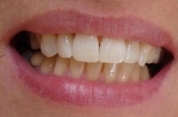 Как отбелить тетрациклиновые зубы: виниры и отбеливание 