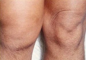 Гнойный артрит коленного сустава 