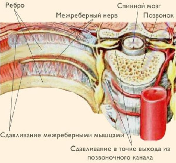 Грудной радикулит: симптомы лечение 