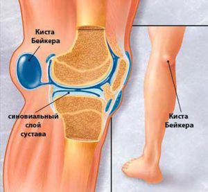 Грыжа Беккера коленного сустава (подколенная) 