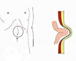 Грыжа белой линии живота 
