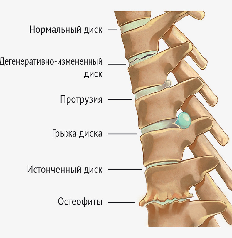 Грыжа диска: запрет на упражнения 