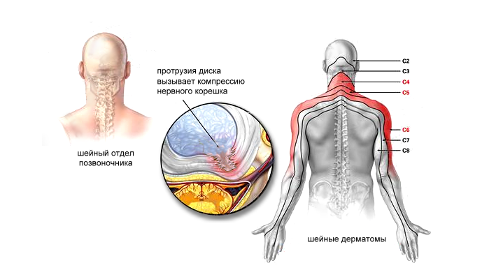 Грыжа дисков шейного отдела позвоночника: C4-C5, C5-C6, C6-C7 