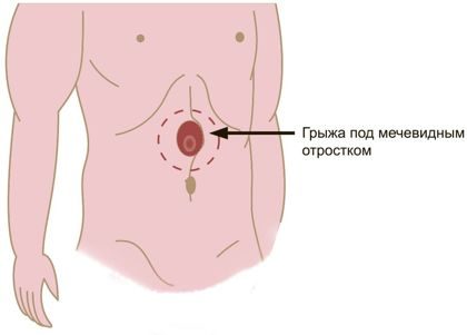 Грыжа мечевидного отростка: симптомы заболевания и его лечение 