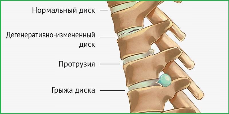 Грыжа позвоночника: симптомы, диагностика, лечение и реабилитация 