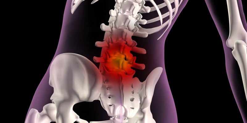 Грыжа позвоночника — симптомы и лечение 