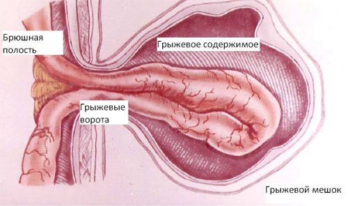 Грыжи передней брюшной стенки 