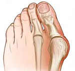 Hallux Valgus. Вальгусное искривление 1го пальца стопы 