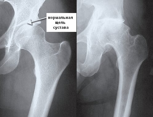 Хаpaктеристика остеохондроза тазобедренного сустава: по каким признакам его распознать, как проходит диагностика и лечение? 