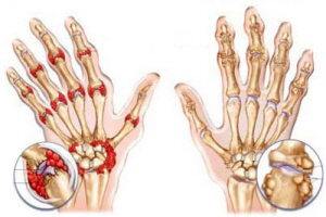 Характерные симптомы и лечение артрита кистей рук 
