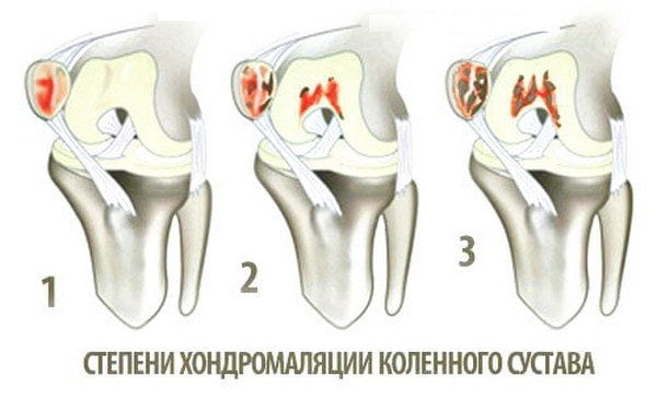 Хондромаляция надколенника и коленного сустава 1, 2 и 3 степени 