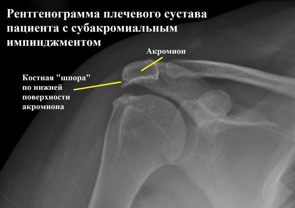 Импинджмент синдром плечевого сустава 