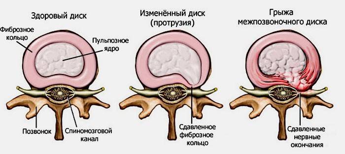 Ишиас — причины, симптомы, лечение 