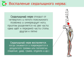 Ишиас – причины возникновения, лечение и операция 