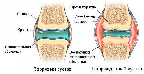 Использование препарата Эсобел для лечения суставов 