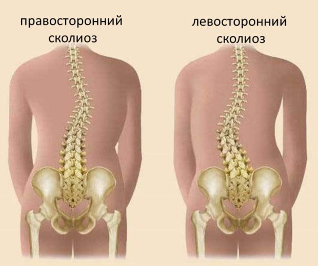 Йога при сколиозе: асаны при разных типах искривления позвоночника 