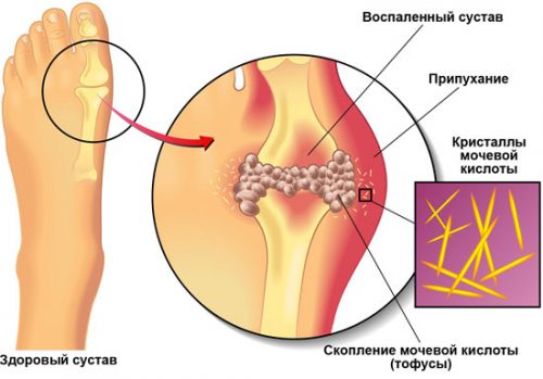 Как бороться с болью при подагре? 