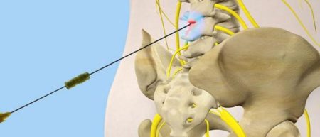 Как делается блокада при грыже поясничного отдела позвоночника? 