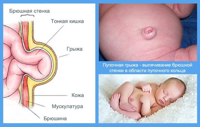 Как делать массаж пупочной грыжи у новорожденных 