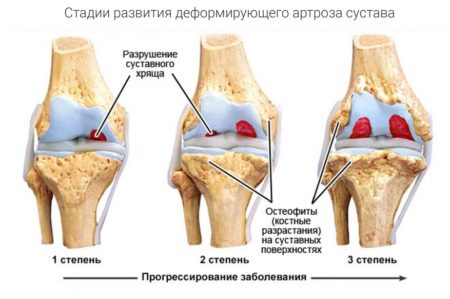 Как делать скипидapные ванны для суставов 