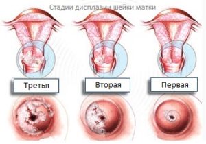 Как дисплазия шейки матки отражается на возможности забеременеть и родить здорового ребенка? 