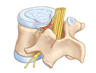 Какие бывают грыжи позвоночника: классификация и описание болезни 