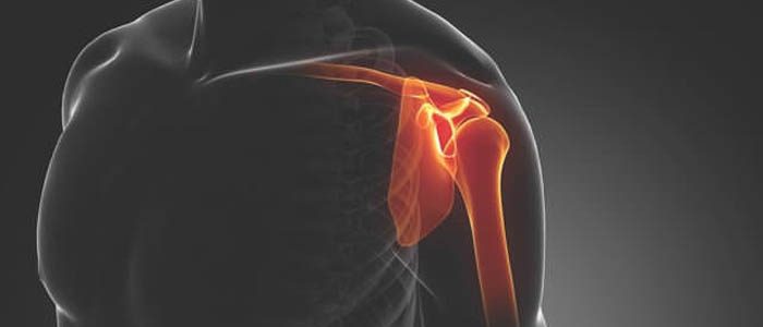 Какие бывают травмы плеча и как их лечить 
