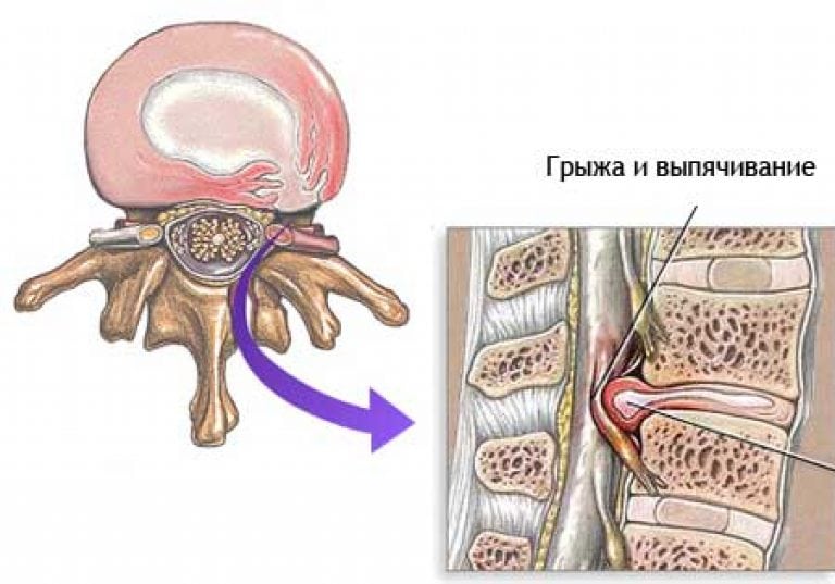 Какие уколы делают при грыже в спине 