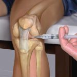 Какие уколы назначит врач при артрозе колена? 