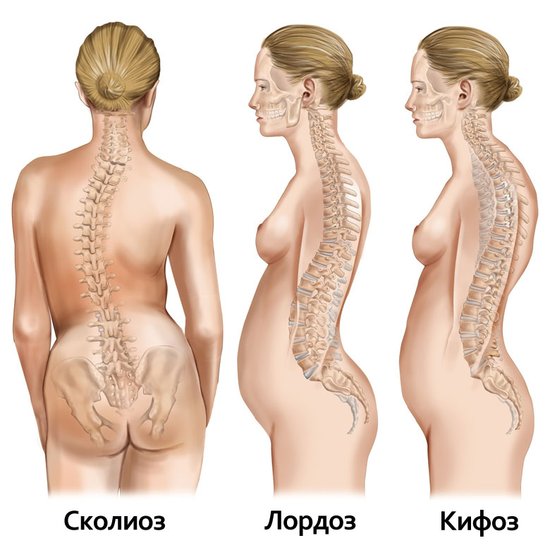 Какие упражнения подойдут при сколиозе 1 и 2 степени у ребенка? 