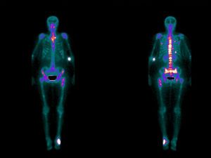 Какие заболевания выявляет сцинтиграфия костей скелета 