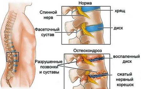 Как использовать Дексаметазон при остеохондрозе? 