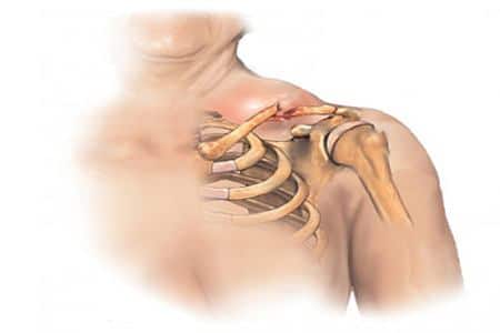 Как избавиться от припухлости, отеков, шишки на шее при остеохондрозе (фото сиптома) 