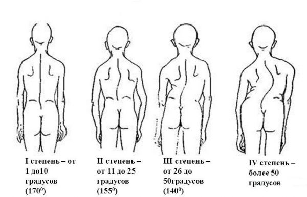 Как лечат сколиоз и какие методы наиболее эффективны 