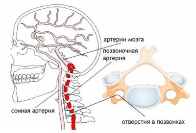 Как лечить головную боль при шейном остеохондрозе? 