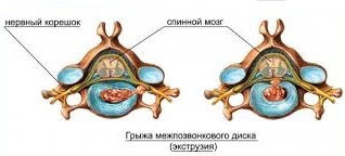 Как лечить грыжу позвоночника: жизненные истории людей 