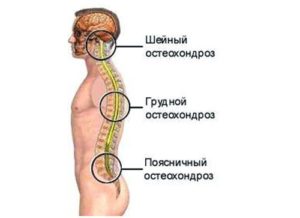 Как лечить хондроз грудной клетки? 