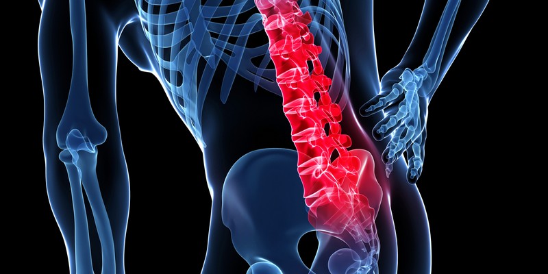 Как лечить хондроз спины? 