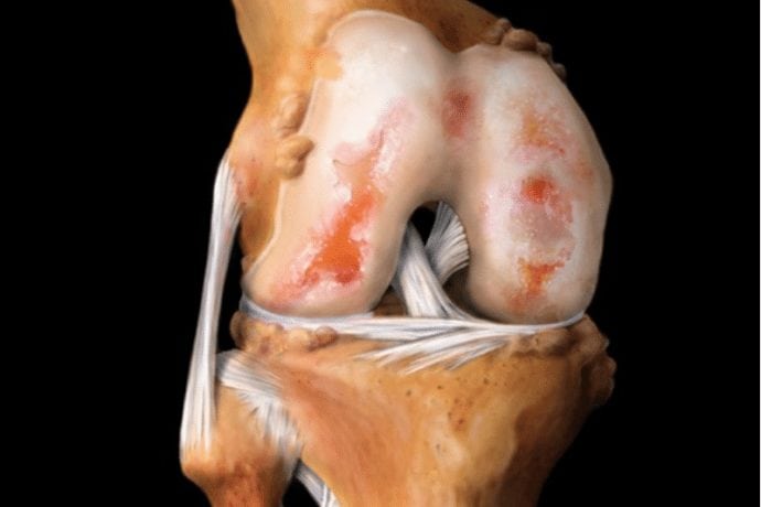 Как лечить истончение гиалинового хряща коленного сустава 