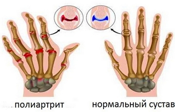 Как лечить полиартрит в домашних условиях 