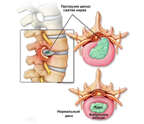 Как лечить протрузии дисков позвоночника дома? 